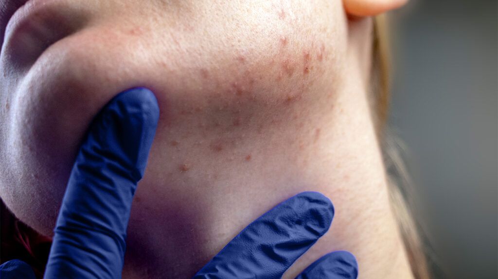 mụn nội tiết mụn nội tiết