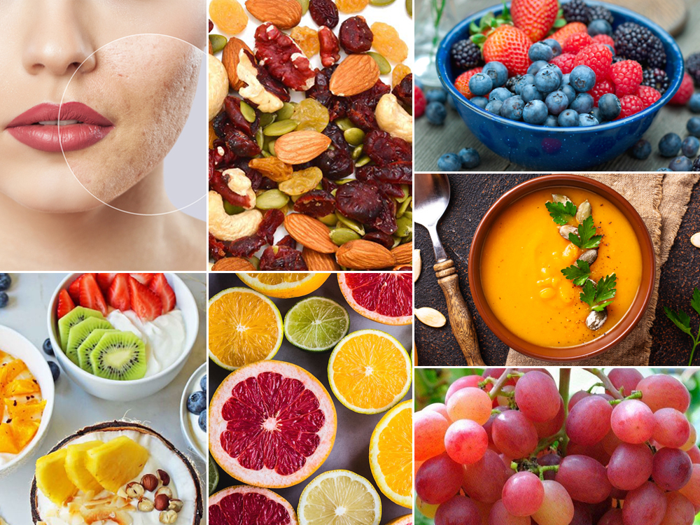 thực phẩm gây mụn thực phẩm gây mụn