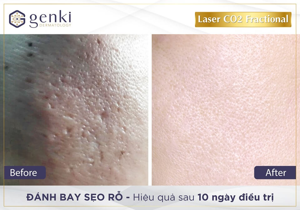 Laser CO2 Fractional trị sẹo mụn Laser CO2 Fractional trị sẹo mụn