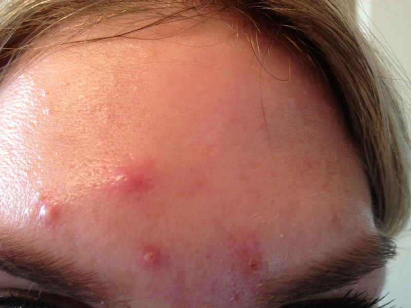 mụn tuổi trưởng thành chu kỳ kinh nguyệt mụn tuổi trưởng thành chu kỳ kinh nguyệt