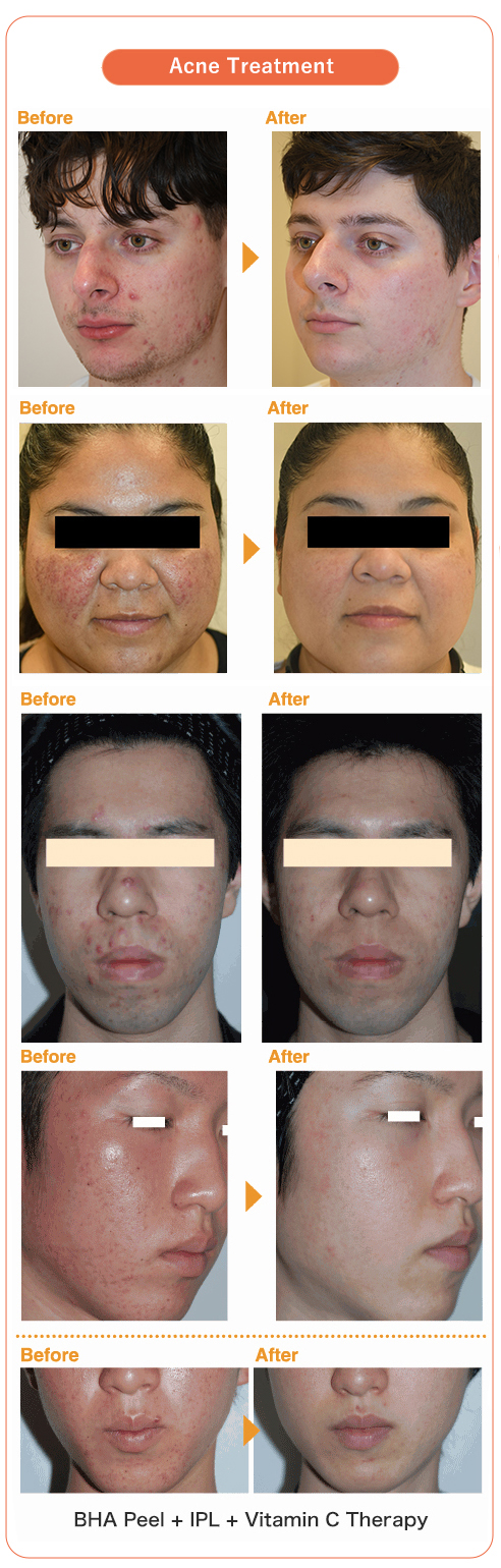 Cấy vitamin trị mụn spa Cấy vitamin trị mụn spa