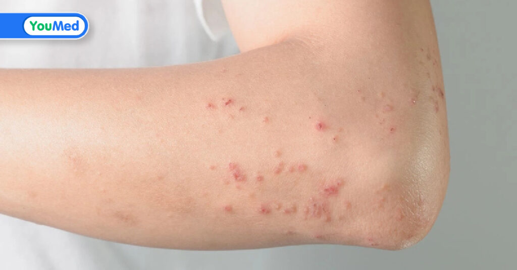 * Da sau khi lấy nhân mụn ngày đầu tiên * Da sau khi lấy nhân mụn ngày đầu tiên