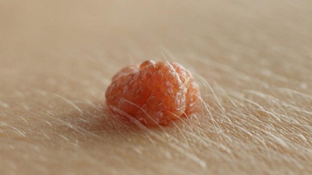 Cách phân biệt mụn nội tiết và mụn thường hình ảnh Cách phân biệt mụn nội tiết và mụn thường hình ảnh