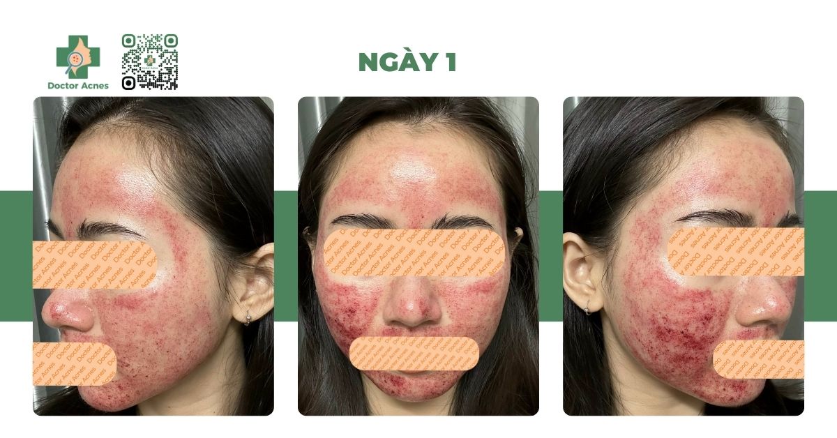 Laser Fractional Nd:YAG 1064nm trị sẹo mụn Laser Fractional Nd:YAG 1064nm trị sẹo mụn