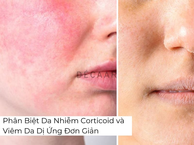 tẩy tế bào chết quá mức gây mụn tẩy tế bào chết quá mức gây mụn