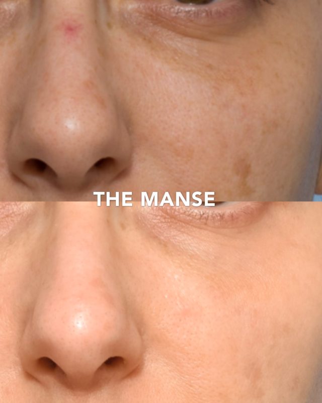 Laser toning melanin trẻ hóa da mặt