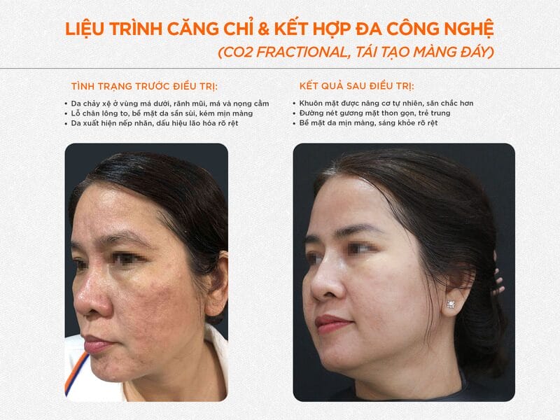 Triệt lông da sáng mịn