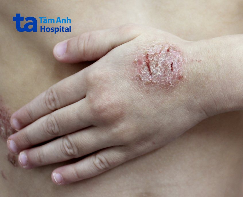 Da đỏ bong vảy Da đỏ bong vảy