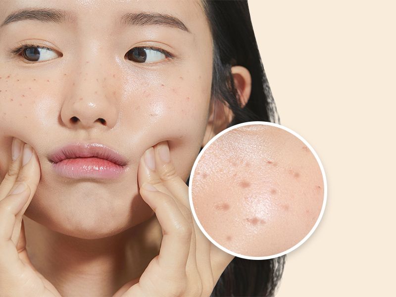 Laser Toning trẻ hóa da mặt