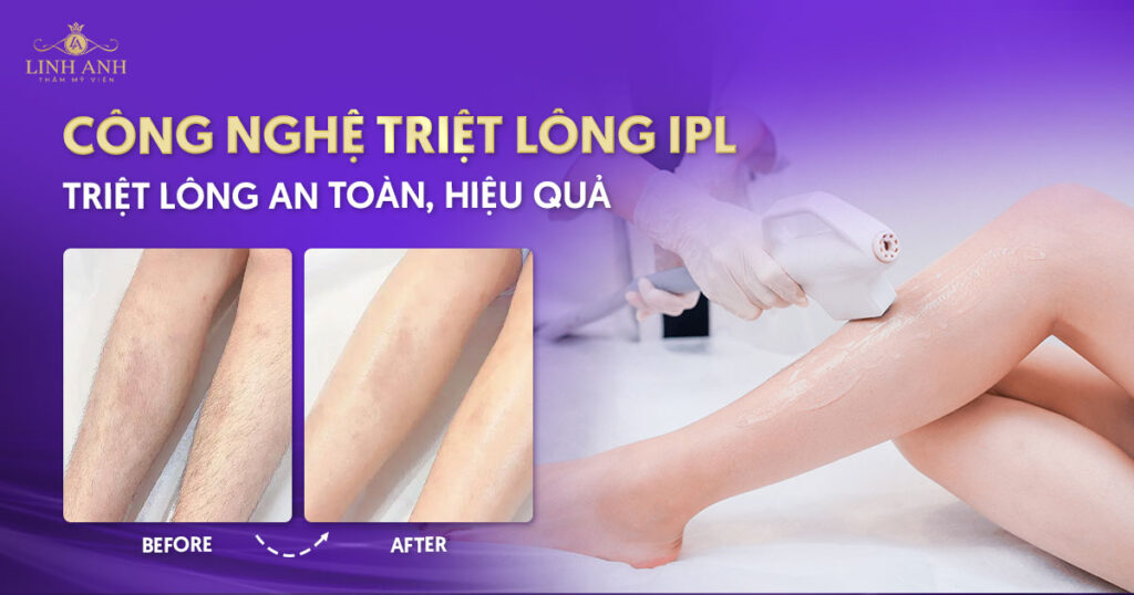 *   Diode Laser triệt lông