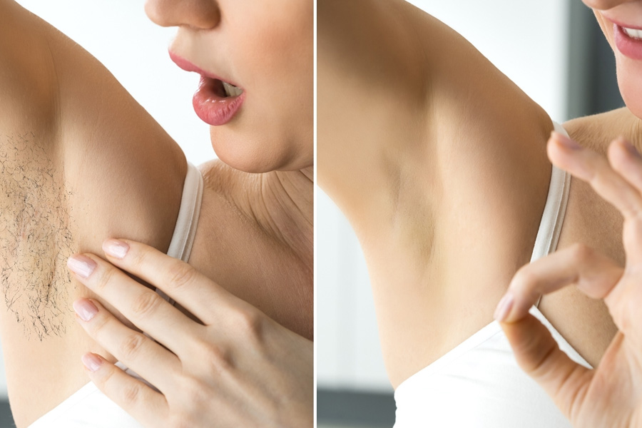 *   triệt lông vĩnh viễn