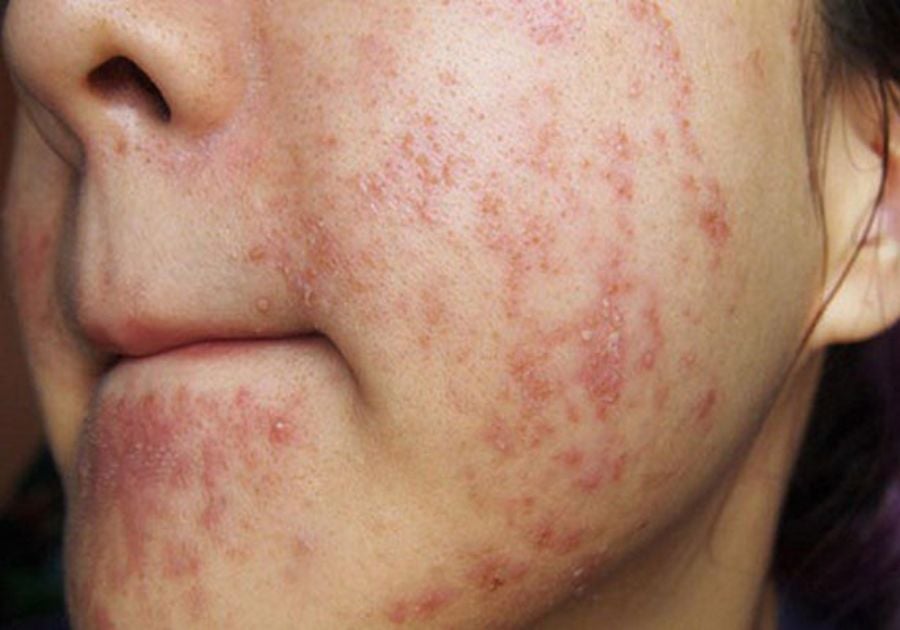 Dị ứng mỹ phẩm: Dị ứng da mỹ phẩm, Kích ứng da mỹ phẩm, Viêm da tiếp xúc mỹ phẩm, Mặt nổi mẩn đỏ dị ứng mỹ phẩm, Triệu chứng dị ứng mỹ phẩm. Dị ứng mỹ phẩm: Dị ứng da mỹ phẩm, Kích ứng da mỹ phẩm, Viêm da tiếp xúc mỹ phẩm, Mặt nổi mẩn đỏ dị ứng mỹ phẩm, Triệu chứng dị ứng mỹ phẩm.