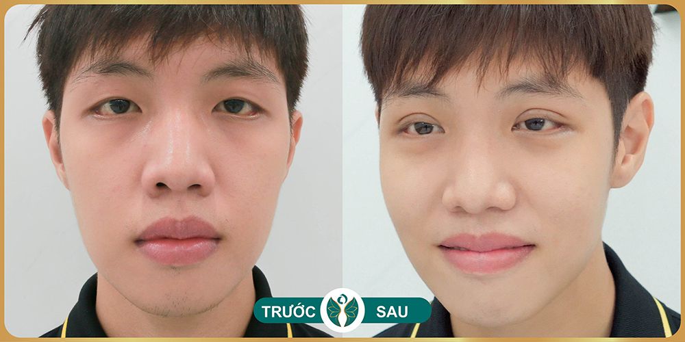 Nam giới triệt lông toàn thân Nam giới triệt lông toàn thân