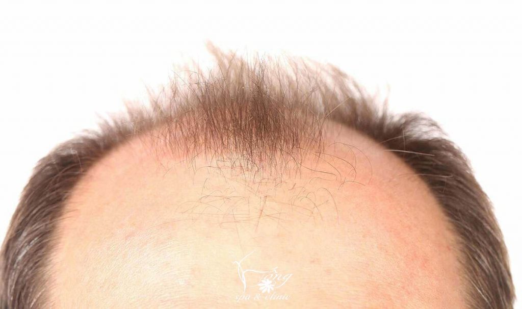 Giai đoạn Telogen triệt lông Giai đoạn Telogen triệt lông