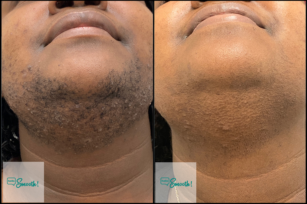 Diode Laser triệt lông da tối màu