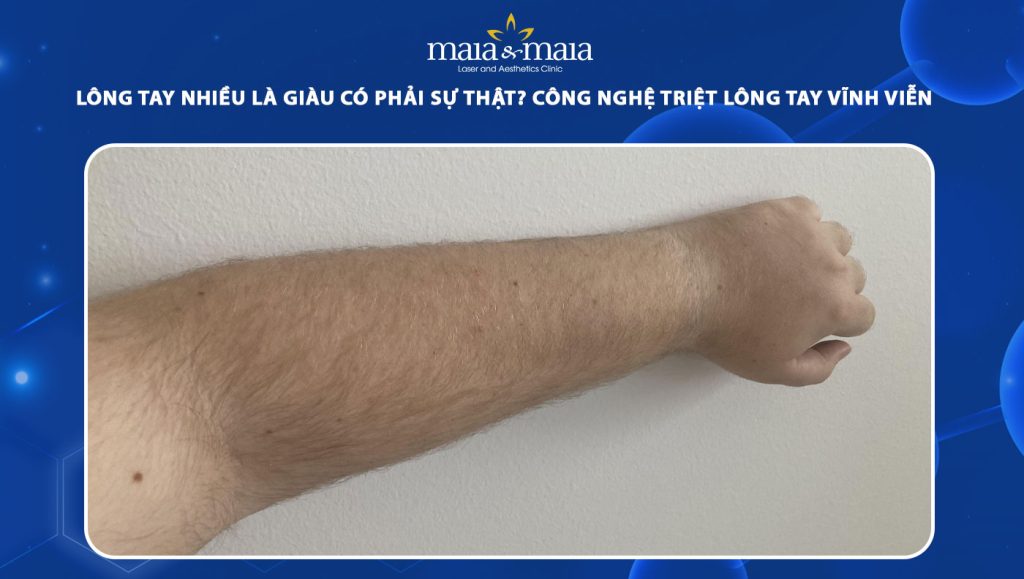 Triệt lông vĩnh viễn