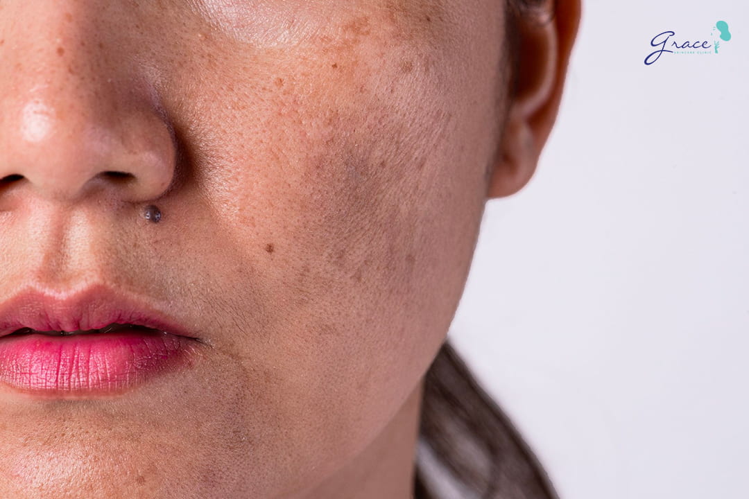 Triệt lông da yếu mỏng