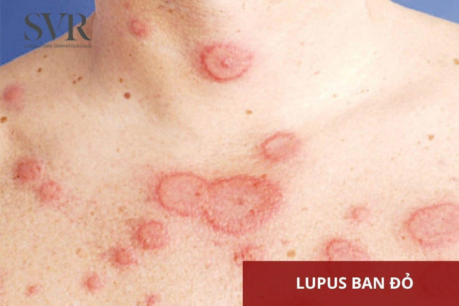 Dị ứng mỹ phẩm da nhạy cảm dấu hiệu