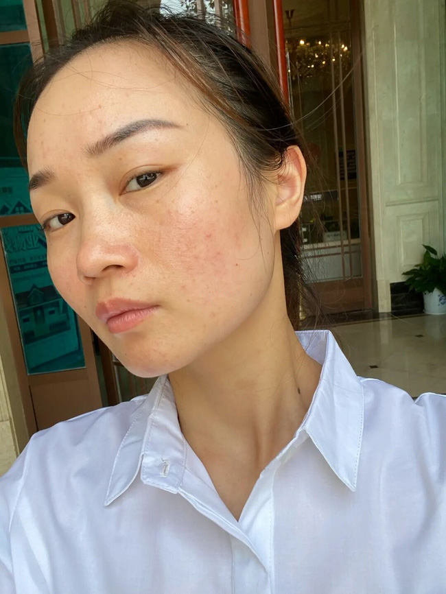 Mụn mủ Mụn mủ