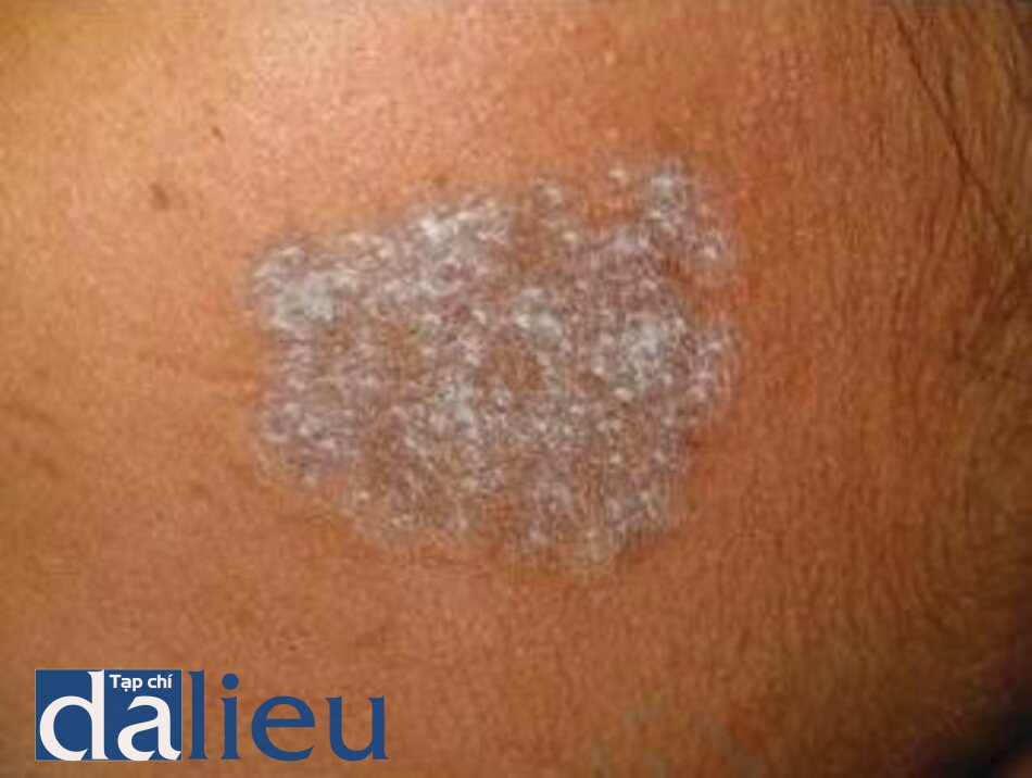 So sánh diode laser và IPL triệt lông, Diode laser vs IPL hair removal comparison, IPL triệt lông nguy cơ da sẫm màu, IPL hair removal dark skin side effects, Diode laser triệt lông da sẫm màu an toàn, IPL bỏng da sẫm màu, Biểu đồ so sánh Diode laser và IPL triệt lông, IPL dark skin risks.