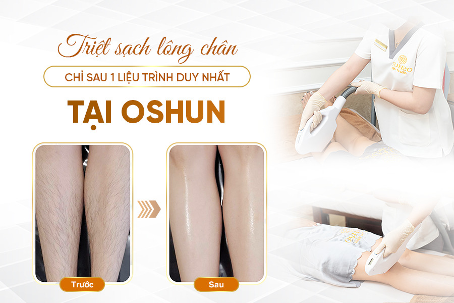 Chăm sóc sau triệt lông toàn thân tại nhà Chăm sóc sau triệt lông toàn thân tại nhà