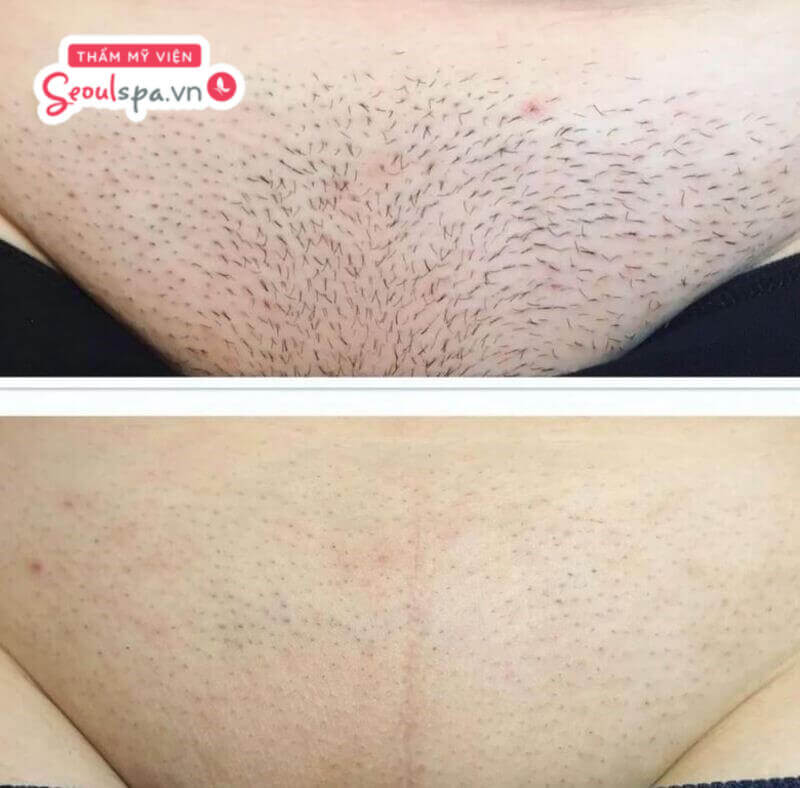 Triệt lông vĩnh viễn lông mọc lại mỏng nhạt thưa