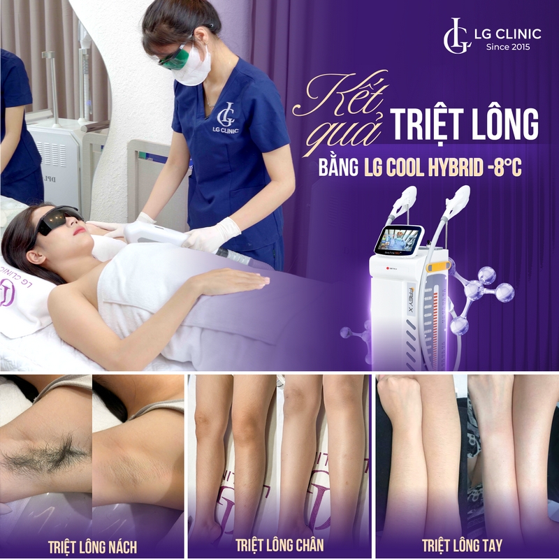 công nghệ triệt lông mới công nghệ triệt lông mới