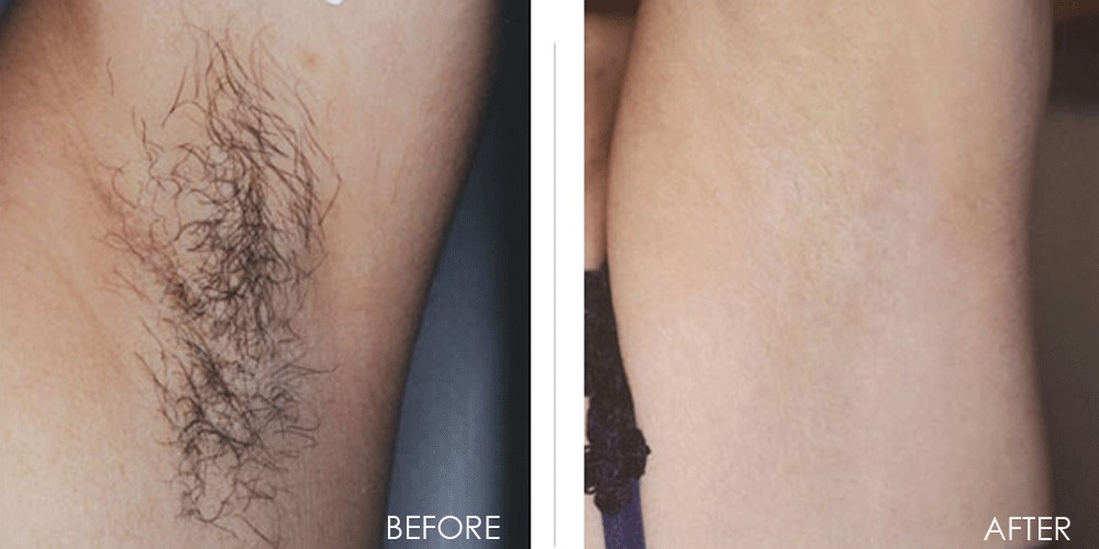 Triệt lông da sáng mịn