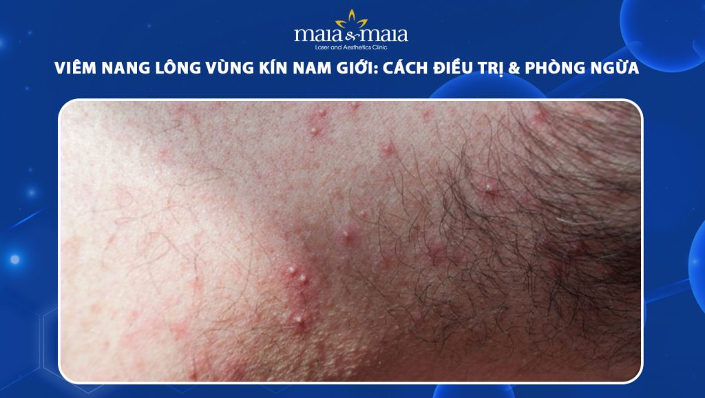 Triệt lông laser nam giới toàn thân Triệt lông laser nam giới toàn thân
