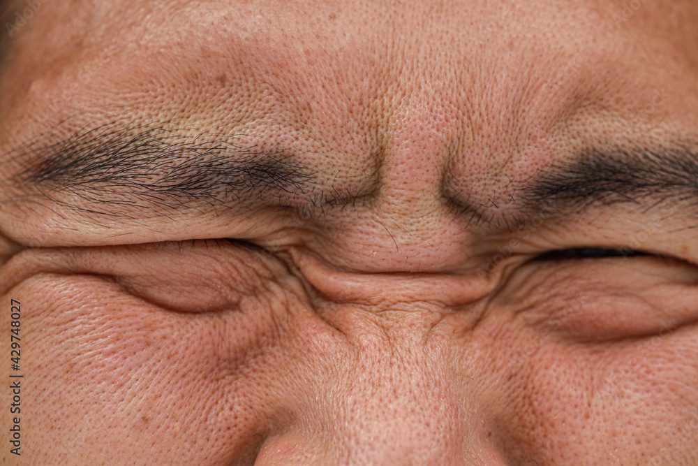 Da dầu nam lỗ chân lông to